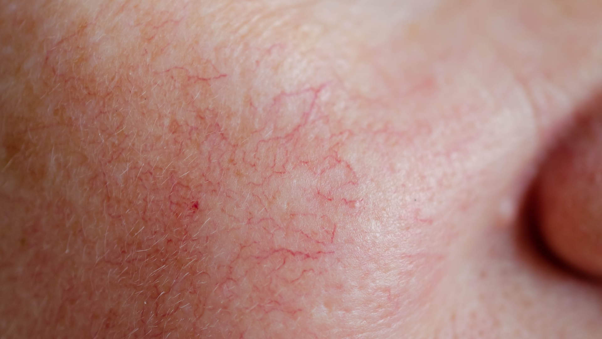LASER VASCULAIRE