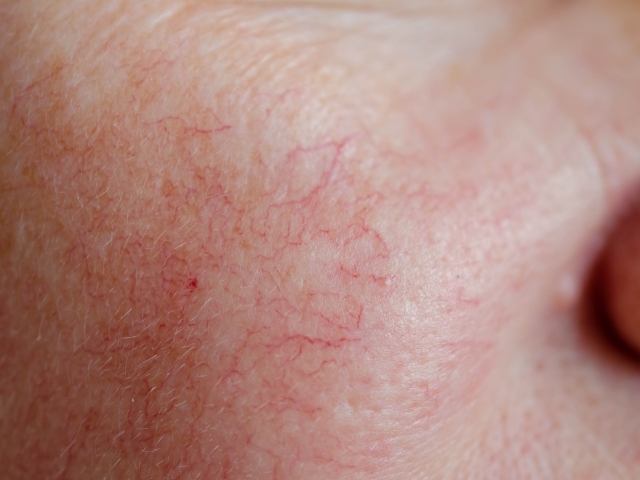 LASER VASCULAIRE